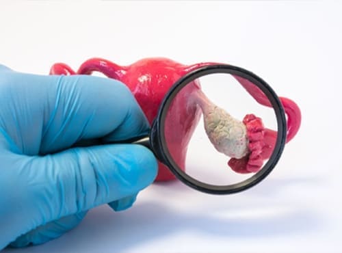 Quistes de ovario Ginecólogo en Monterrey