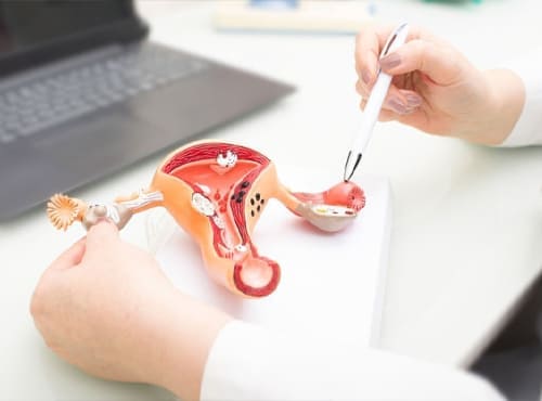 Síndrome de ovario poliquístico ginecologo en monterrey